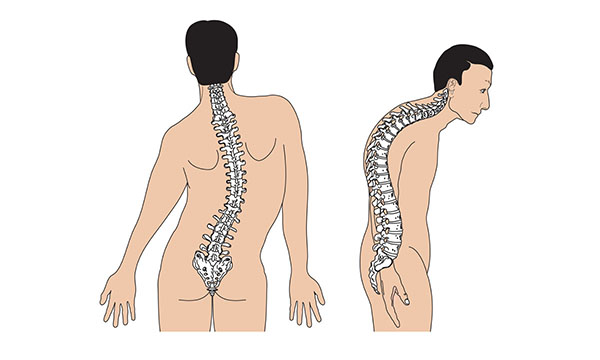 Cong vẹo cột sống là bệnh lý xương khớp ai cũng có thể mắc phải