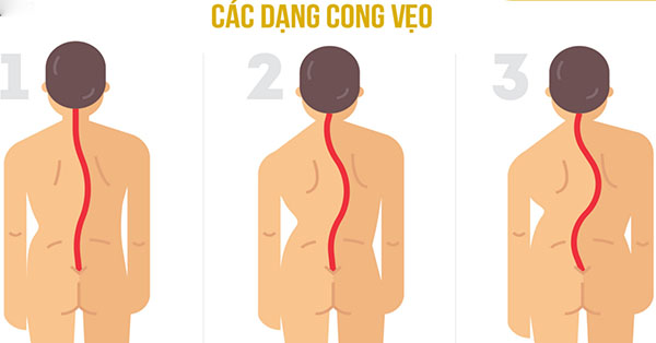 Một số dạng cong vẹo cột sống ở người lớn