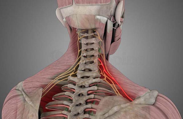 Biến chứng của gai cột sống cổ rất nguy hiểm