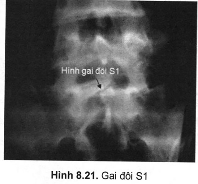 Hình ảnh gai đôi cột sống s1