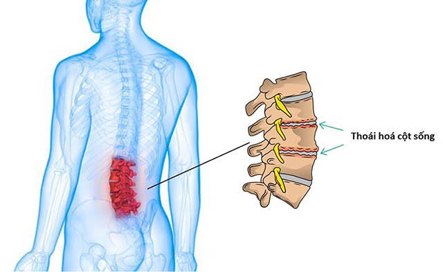 Thoái hóa đốt sống lưng là bệnh mãn tính