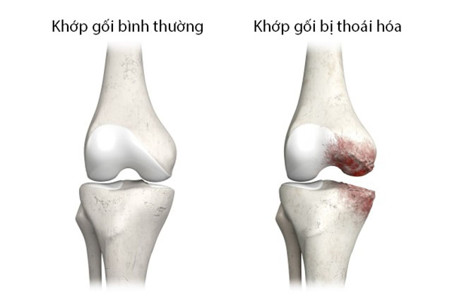 Thoái hóa khớp gối là bệnh lý phổ biến