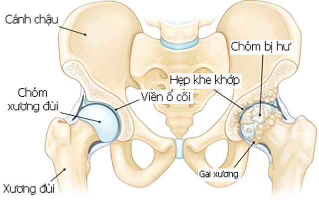 Bệnh thoái hóa khớp háng đang có xu hướng trẻ hóa