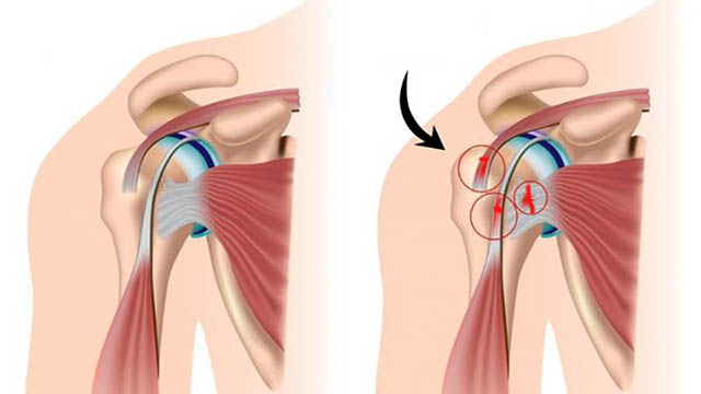 Phẫu thuật được áp dụng với trường hợp thoái hóa khớp vai nặng