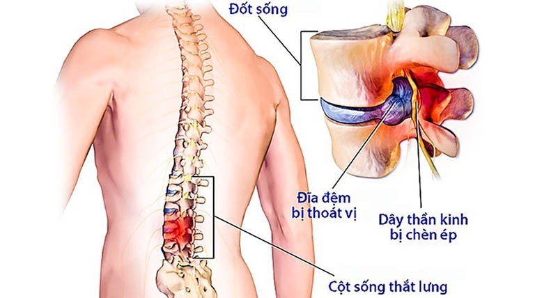 Hình ảnh thoát vị đĩa đệm