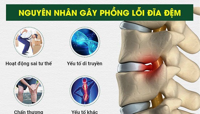 Có nhiều nguyên nhân gây phồng đĩa đệm