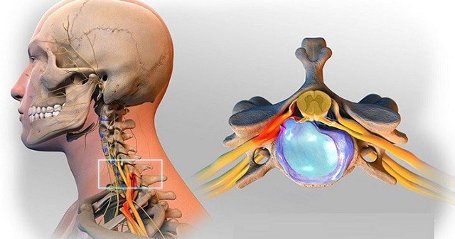 Thoát vị đĩa đệm cổ gây đau đớn cho người bệnh