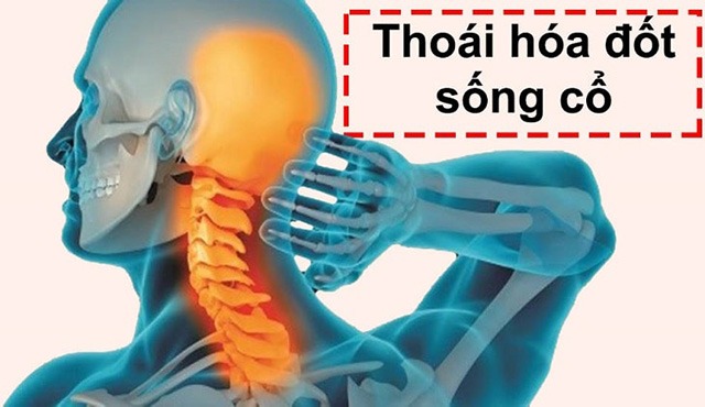 Thoái hóa là một trong những nguyên nhân chính gây thoát vị đĩa đệm cổ