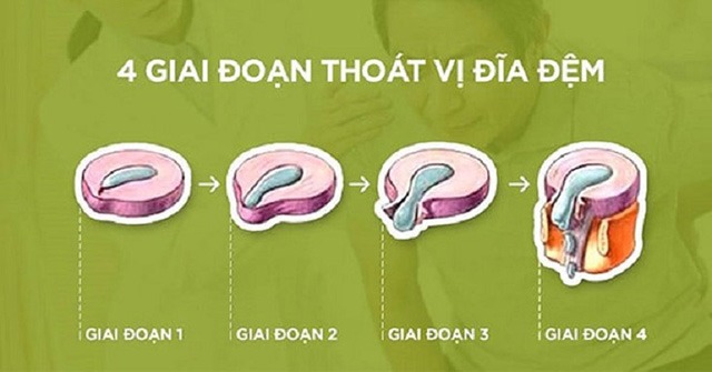 Các giai đoạn bệnh thoát vị đĩa đệm