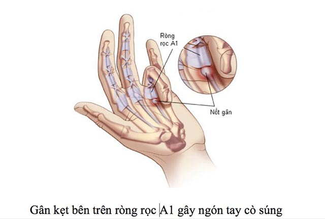 Ngón tay cò súng còn được gọi là hội chứng ngón tay bật