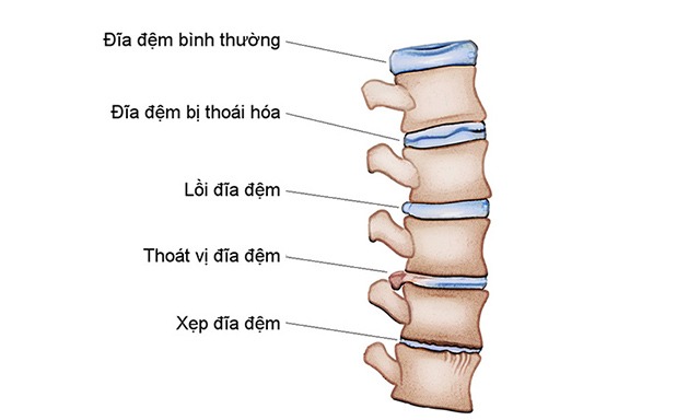 Một số hình ảnh chi tiết về xẹp đĩa đệm