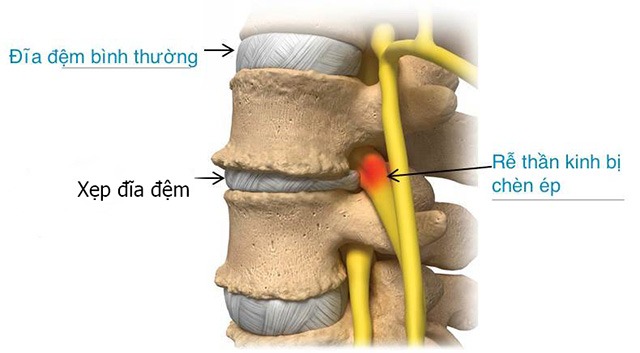 Một số hình ảnh chi tiết về xẹp đĩa đệm