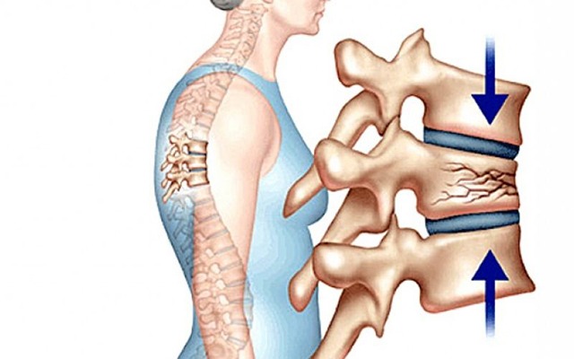 Một số hình ảnh chi tiết về xẹp đĩa đệm