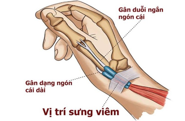 Hình ảnh chi tiết về hội chứng de quervain