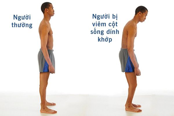 Người bị viêm cột sống dính khớp không đứng được thẳng