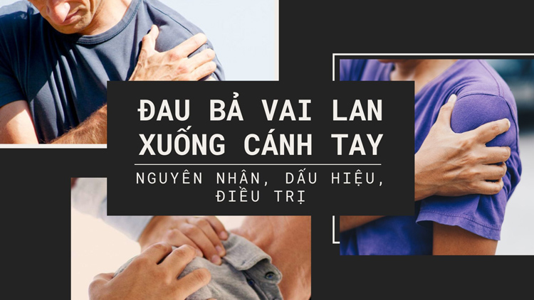 Đau vai lan xuống cánh tay: Nguyên nhân, dấu hiệu, điều trị