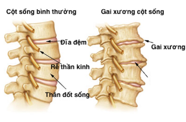 Hình ảnh gai cột sống theo từng giai đoạn?