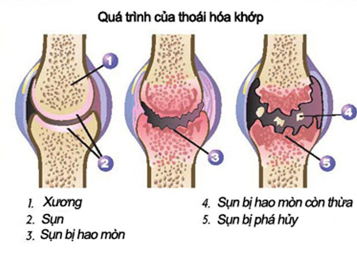 Thoái hóa khớp gối: Tìm hiểu nguyên nhân, triệu chứng và cách trị