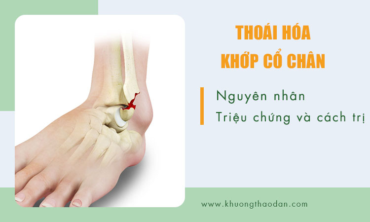 Thoái Hóa Khớp Cổ Chân: Tìm Hiểu Nguyên Nhân Và Hướng Điều Trị