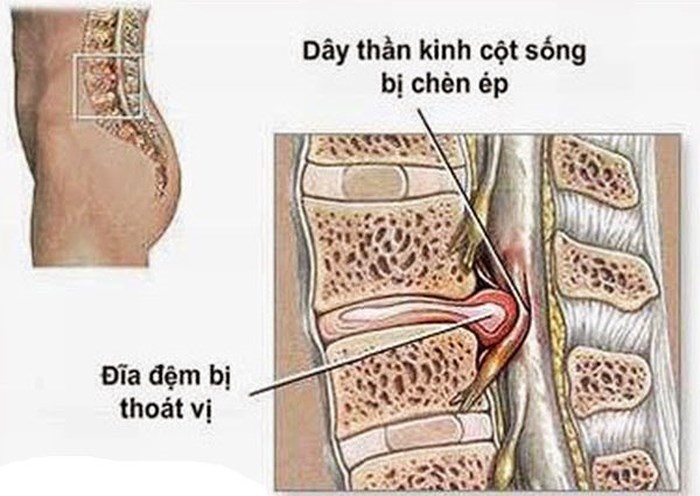 Thoát vị đĩa đệm: Tổng hợp thông tin chính xác về bệnh