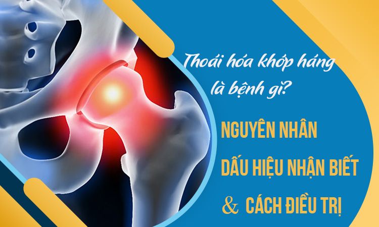 Thoái Hóa Khớp Háng: Tìm Hiểu Nguyên Nhân, Triệu Chứng, Cách Chữa