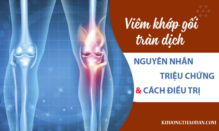 Tràn Dịch Khớp Gối Là Bệnh Gì? Nguyên Nhân, Triệu Chứng Và Cách Đặc Trị