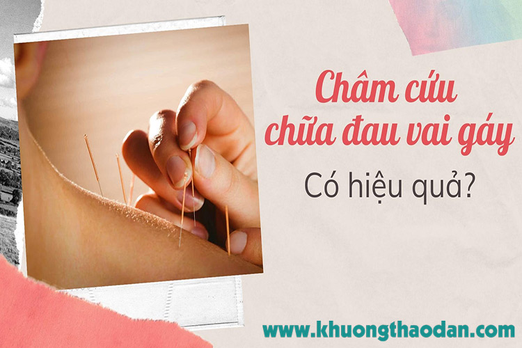 Châm cứu đau vai gáy: Tác dụng, Đối tượng và các bước chuẩn bị