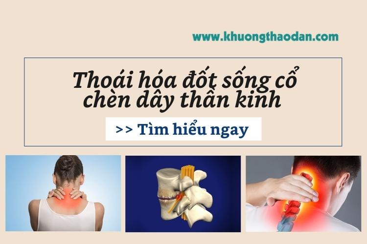 Đừng chủ quan khi thoái hóa đốt sống cổ chèn dây thần kinh