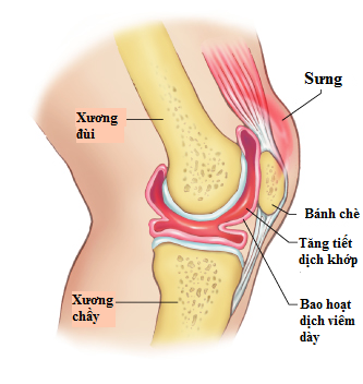 Nguyên nhân mỏi khớp gối ở người trẻ tuổi và cách chữa thế nào?