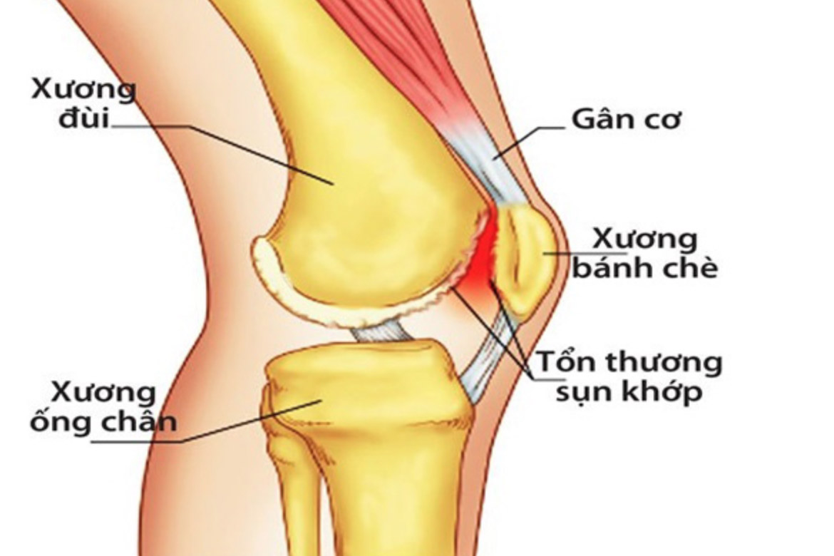 Hướng dẫn lập kế hoạch chăm sóc bệnh nhân đau khớp gối