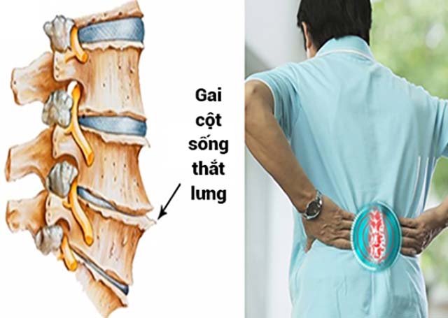 Gai Cột Sống Thắt Lưng Là Gì? Có Nguy Hiểm Không? Chữa Được Không?