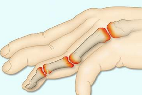 Viêm Khớp Ngón Tay: Nguyên Nhân, Triệu Chứng, Cách Chữa Hiệu Quả