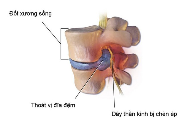 Thoái Hóa Đốt Sống Lưng L4 L5: Dấu Hiệu, Nguyên Nhân & Cách Chữa