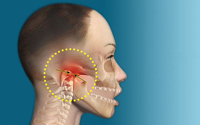 Bệnh rối loạn khớp thái dương hàm là gì? Nguyên nhân, triệu chứng