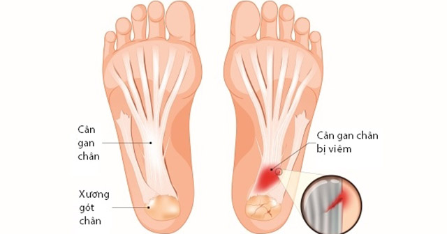 Viêm Cân Gan Chân Là Gì? Nguyên Nhân Gây Bệnh Và cách Chữa