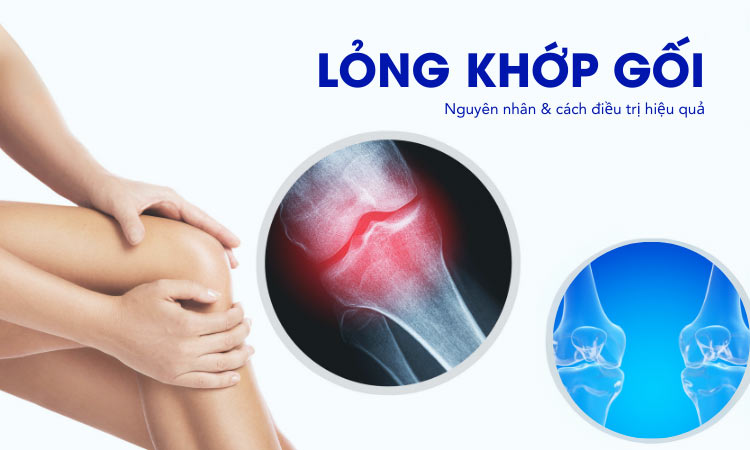 [Cẩm nang] Lỏng khớp gối - Nguyên nhân & cách điều trị hiệu quả