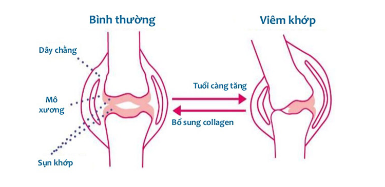 Tác dụng của Collagen không biến tính type II với tình trạng viêm khớp.