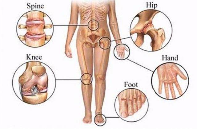 Thoái hóa đa khớp thường xuất hiện ở các khớp phải chịu trọng lượng lớn như cột sống, khớp háng, khớp gối...