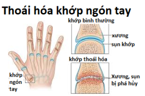 Thoái hóa khớp ngón tay