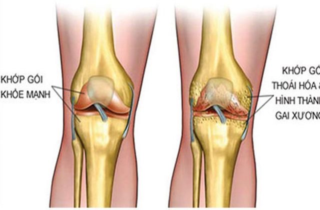 Gai mâm chày khớp gối hình thành do thoái hóa xương khớp