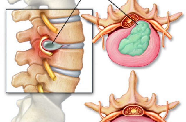Hình ảnh mô tả thoát vị đĩa đệm