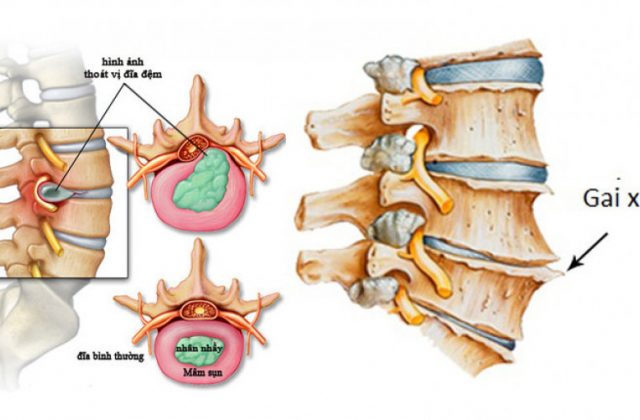 Hình ảnh mô tả gai xương