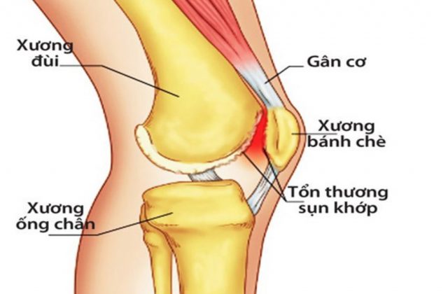 Thoái hóa khớp gối là do tổn thương của sụn khớp (Ảnh minh họa)