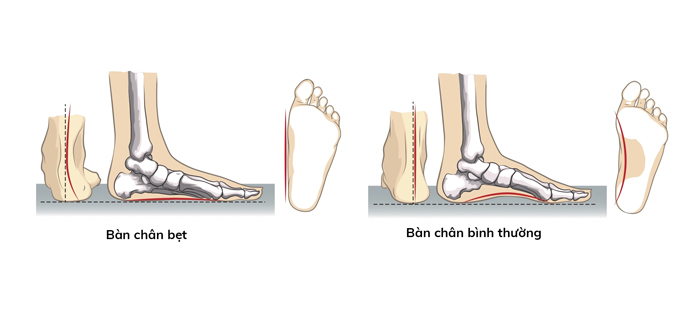 Hội chứng bàn chân bẹt