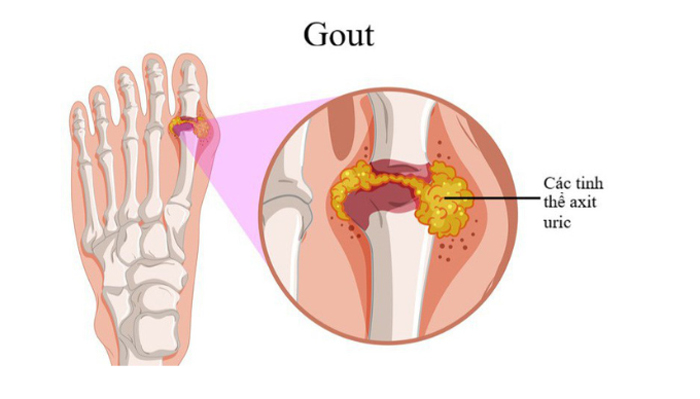 Bệnh gút thường gây đau ở ngón chân, đặc biệt là khớp gốc ngón chân cái (Ảnh minh họa)