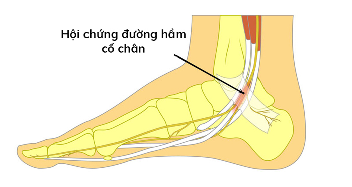 Hội chứng đường hầm cổ chân có thể gây tê, đau, ngứa ran như kiến bò ở bất kỳ vị trí nào mà dây thần kinh chày sau đi qua