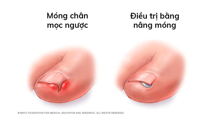 Hình ảnh móng chân mọc ngược