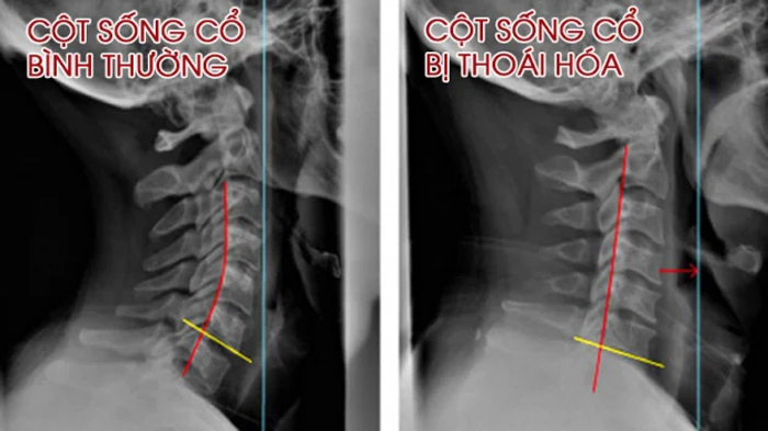 Thoái hóa cột sống cổ