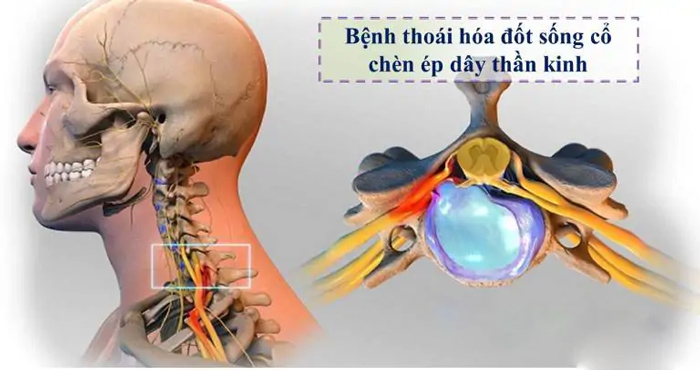 Thoái hóa đốt sống cổ có thể dẫn đến đau cổ, tê yếu ở cánh tay, bàn tay, chân hoặc bàn chân (Ảnh minh họa)