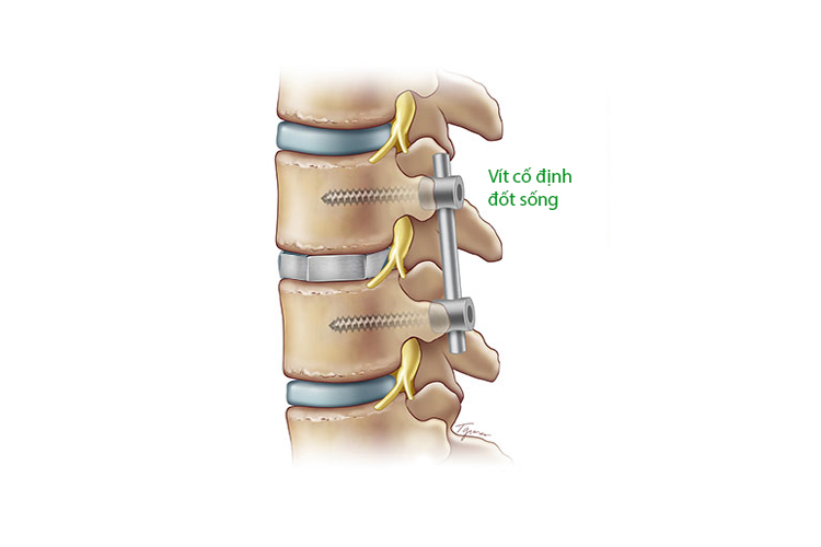 Phẫu thuật cố định cột sống (Ảnh minh họa)